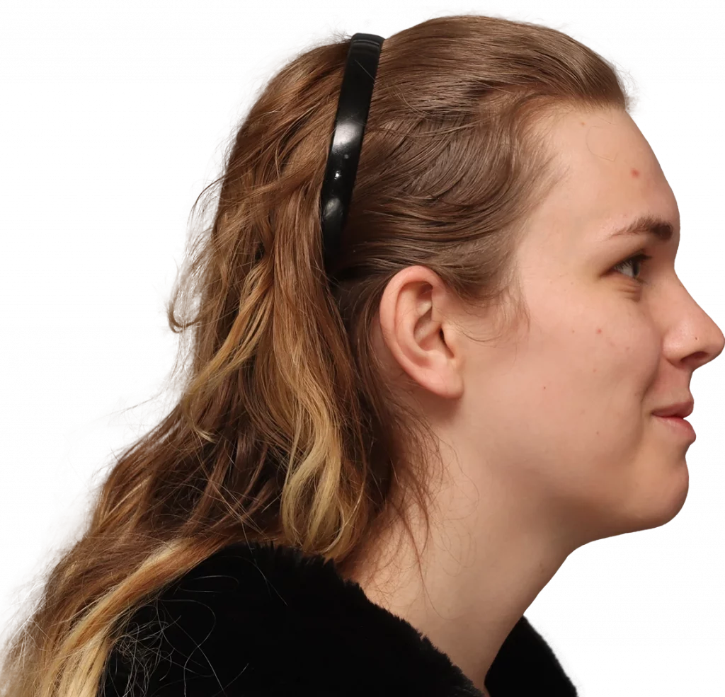 Side right profile photo of Lilly C. before surgery.