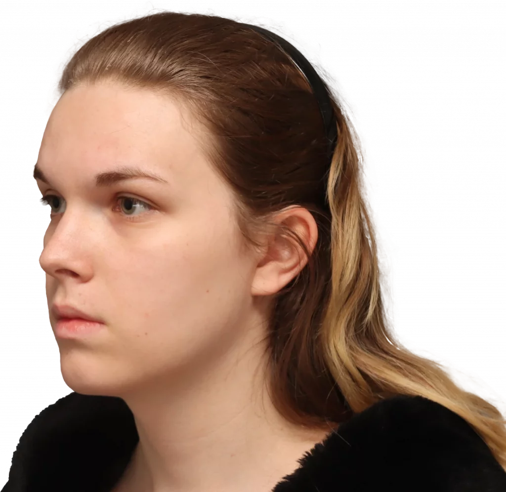 Side left profile photo of Lilly C. before surgery.