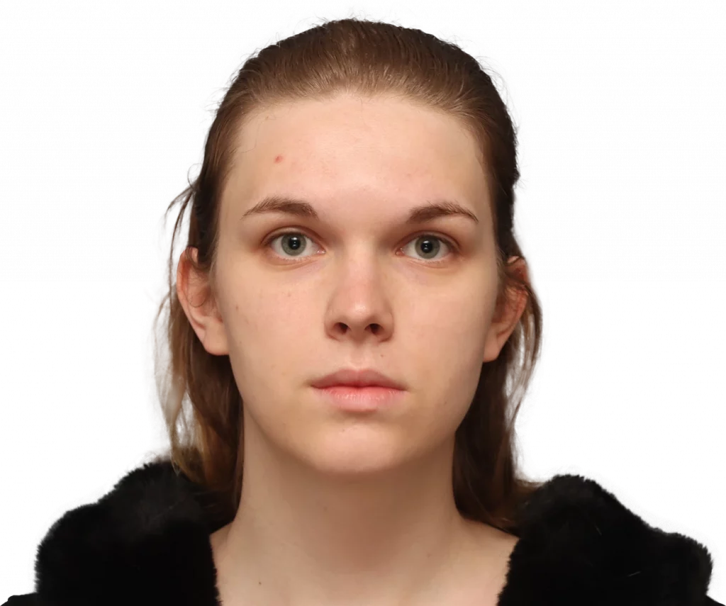 Front profile photo of Lilly C. before surgery.