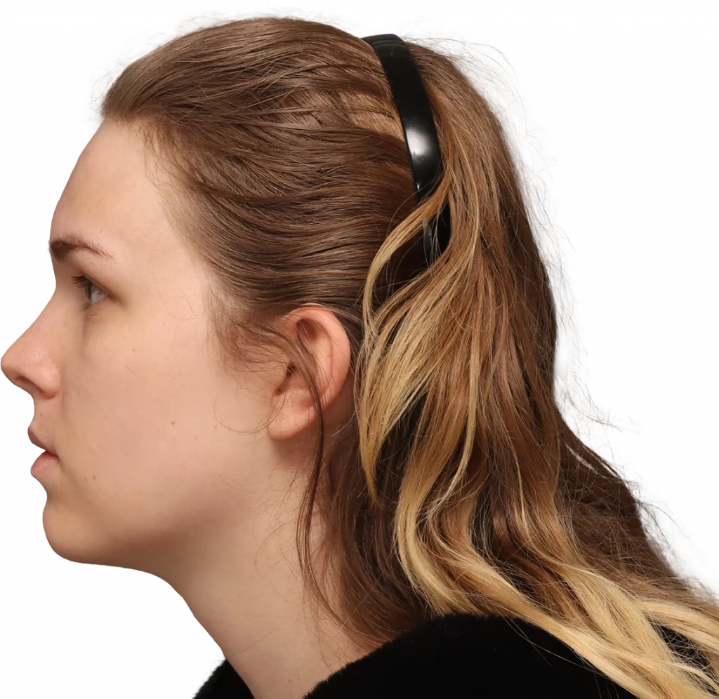 Side left profile photo of Lilly C. before surgery.