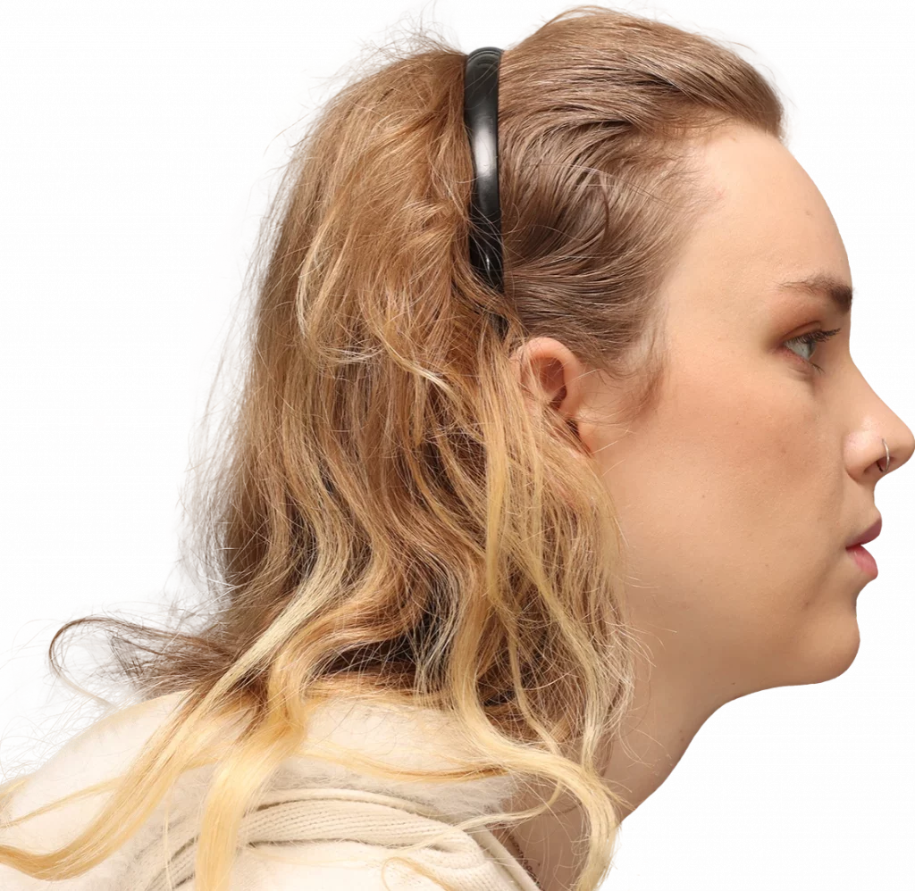 Side right profile photo of Lilly C. after surgery.