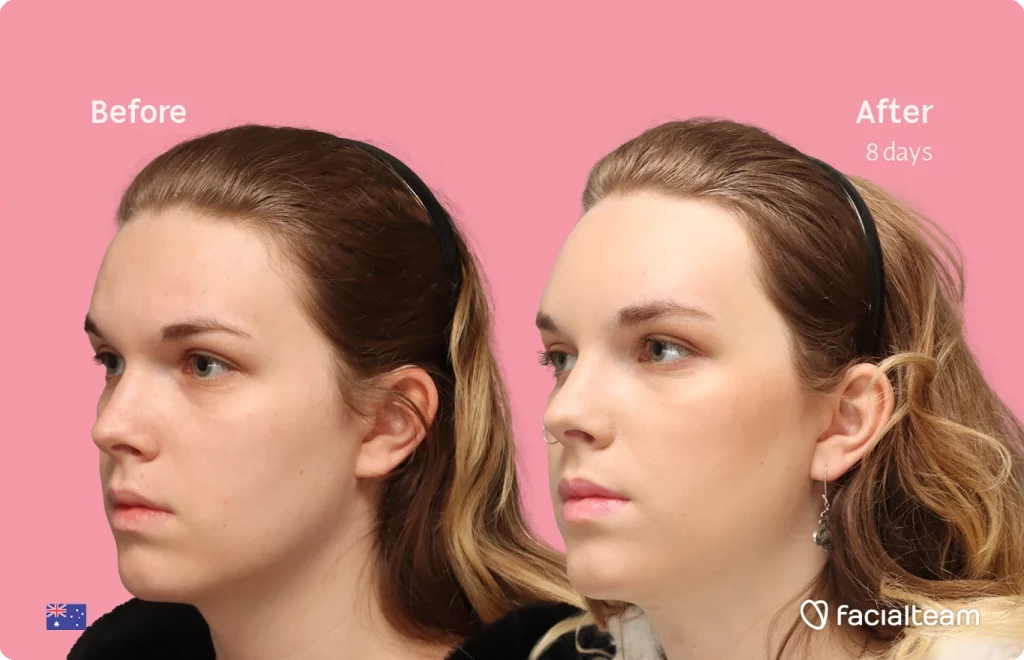 Angled left image of FFS patient Lily C. showing the results before-after with Facialteam consisting of Forehead and tracheal shave Feminization surgery.