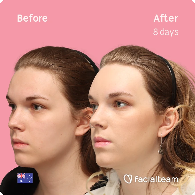 Angled left image of FFS patient Lily C. showing the results before-after with Facialteam consisting of Forehead and tracheal shave Feminization surgery.