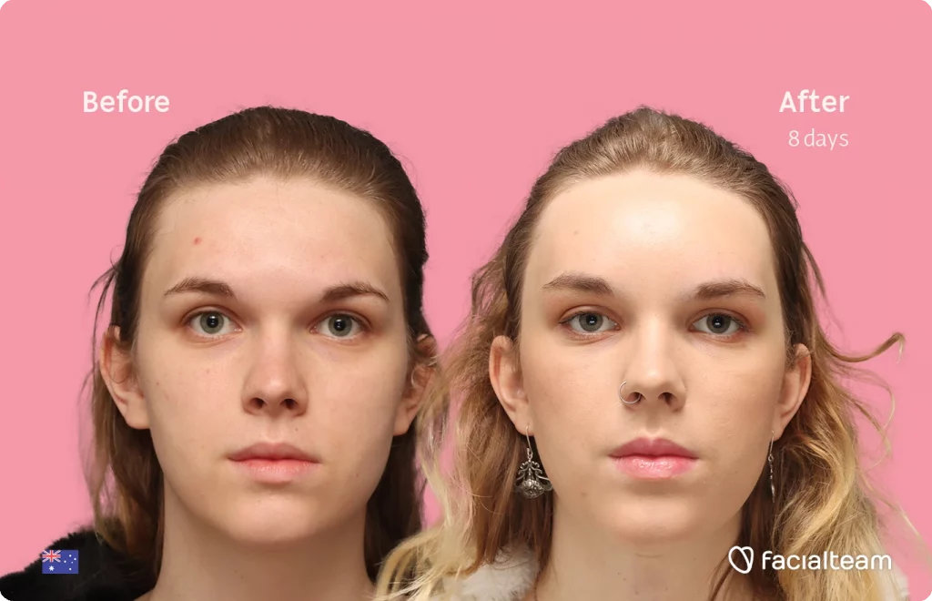 Frontal image of FFS patient Lily C. showing the results before-after with Facialteam consisting of Forehead and tracheal shave Feminization surgery.