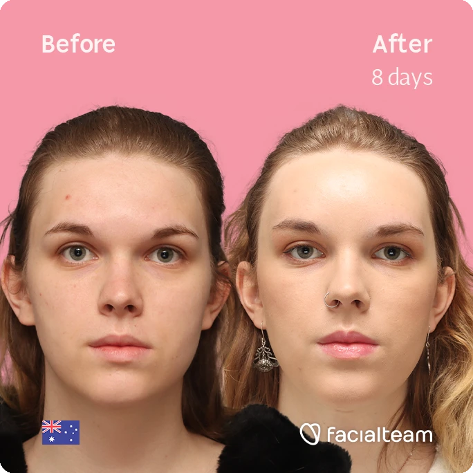 Frontal square image of FFS patient Lily C. showing the results before-after with Facialteam consisting of Forehead and tracheal shave Feminization surgery.