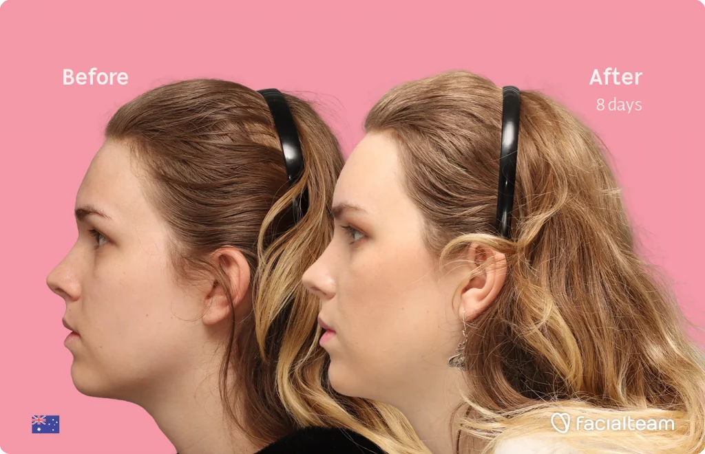 Side left image of FFS patient Lily C. showing the results before-after with Facialteam consisting of Forehead and tracheal shave Feminization surgery.