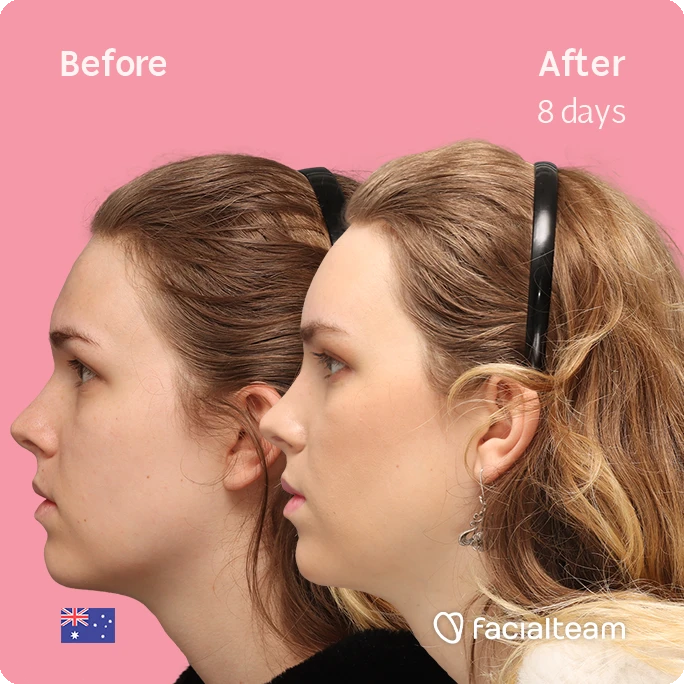 Side left square image of FFS patient Lily C. showing the results before-after with Facialteam consisting of Forehead and tracheal shave Feminization surgery.