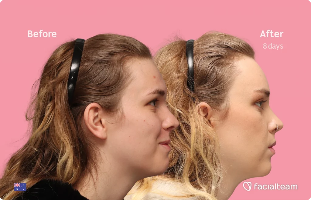 Side right image of FFS patient Lily C. showing the results before-after with Facialteam consisting of Forehead and tracheal shave Feminization surgery.