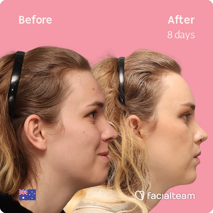 Side right square image of FFS patient Lily C. showing the results before-after with Facialteam consisting of Forehead and tracheal shave Feminization surgery.