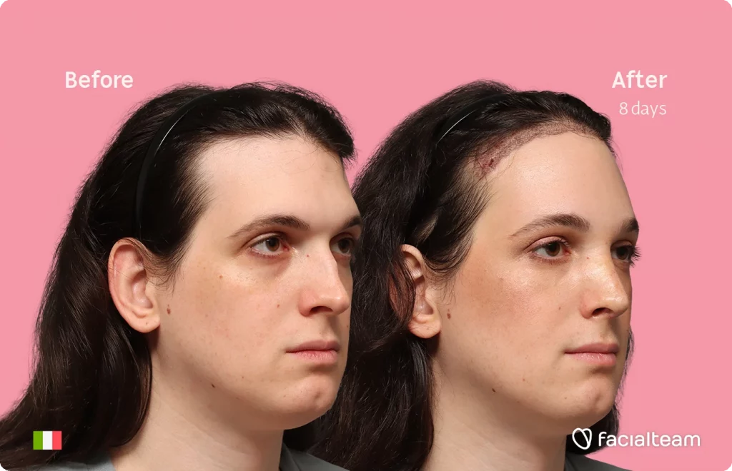Angled right image of FFS patient Fiore showing the results before-after with Facialteam consisting of Forehead with SHT and rhinoplasty Feminization surgery.