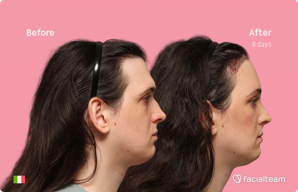 Side right image of FFS patient Fiore showing the results before-after with Facialteam consisting of Forehead with SHT and rhinoplasty Feminization surgery.