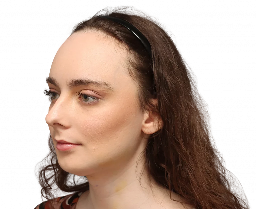 Angled left profile photo of Alex M after surgery.