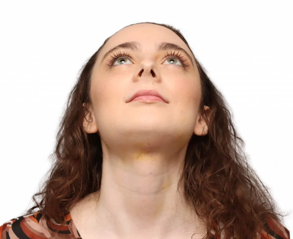 Frontal up profile photo of Alex M after surgery.