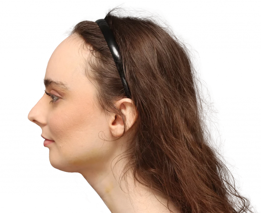 Side left profile photo of Alex M after surgery.