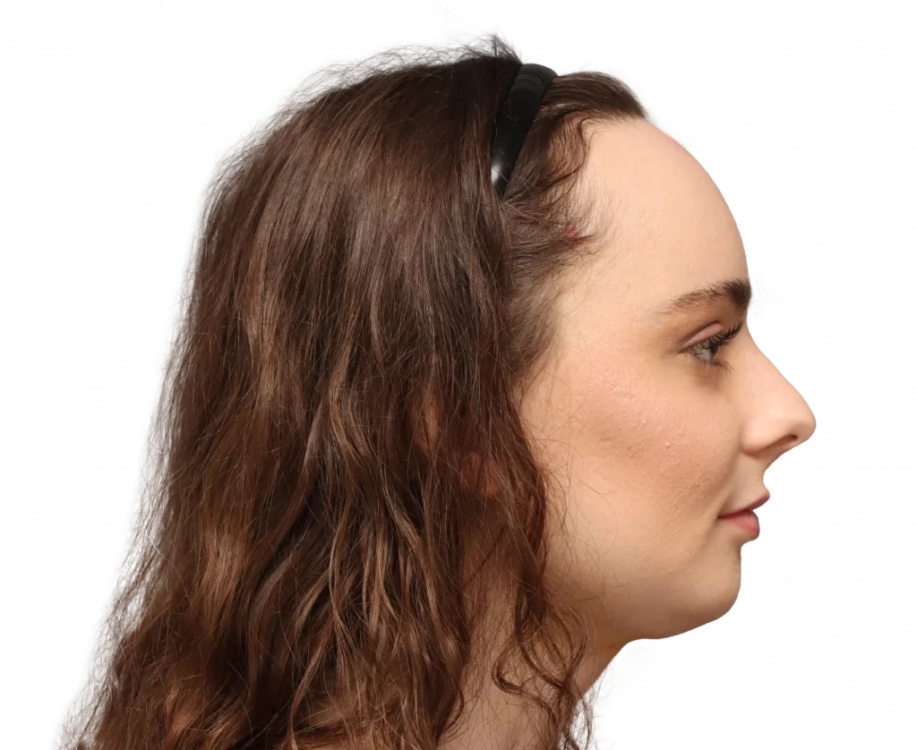 Side right profile photo of Alex M after surgery.