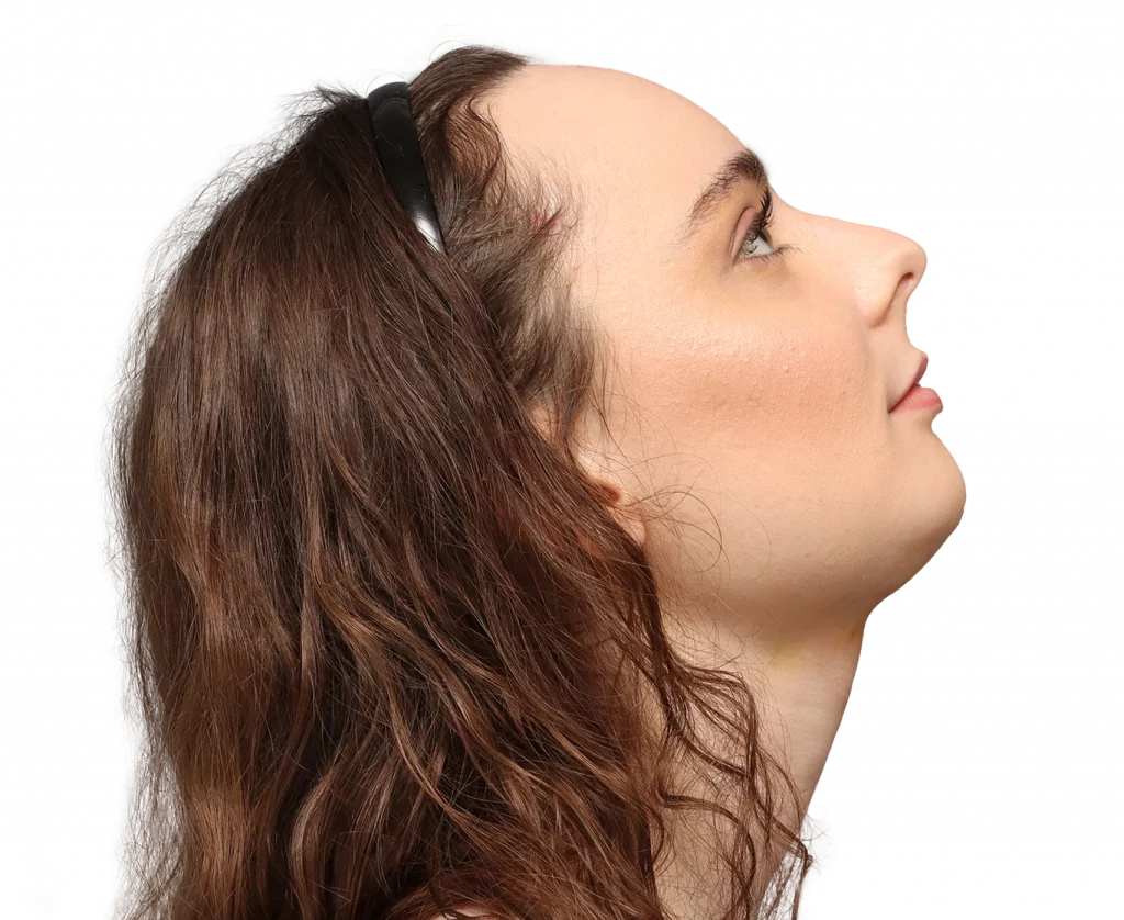 Side right up profile photo of Alex M after surgery.