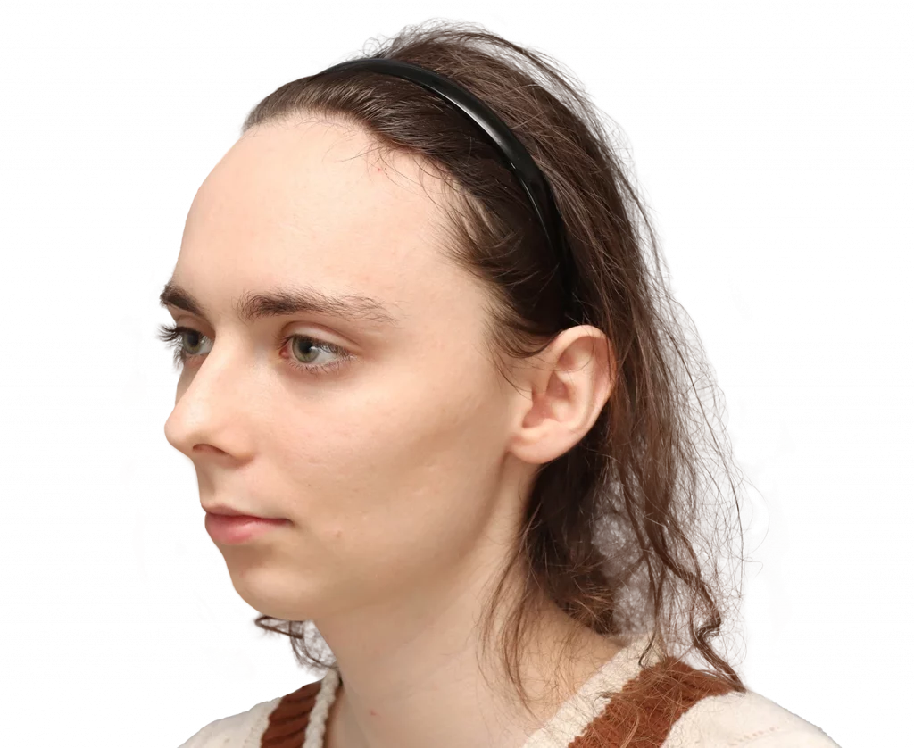 Angled left profile photo of Alex M before surgery.