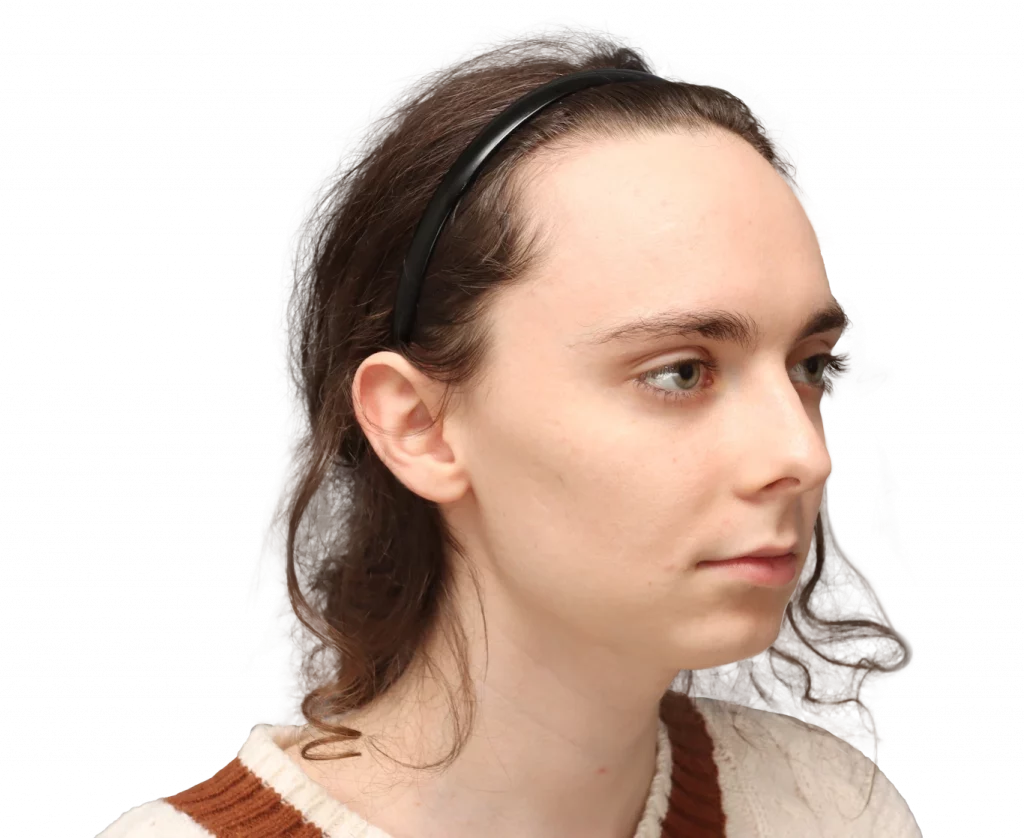 Angled right profile photo of Alex M before surgery.