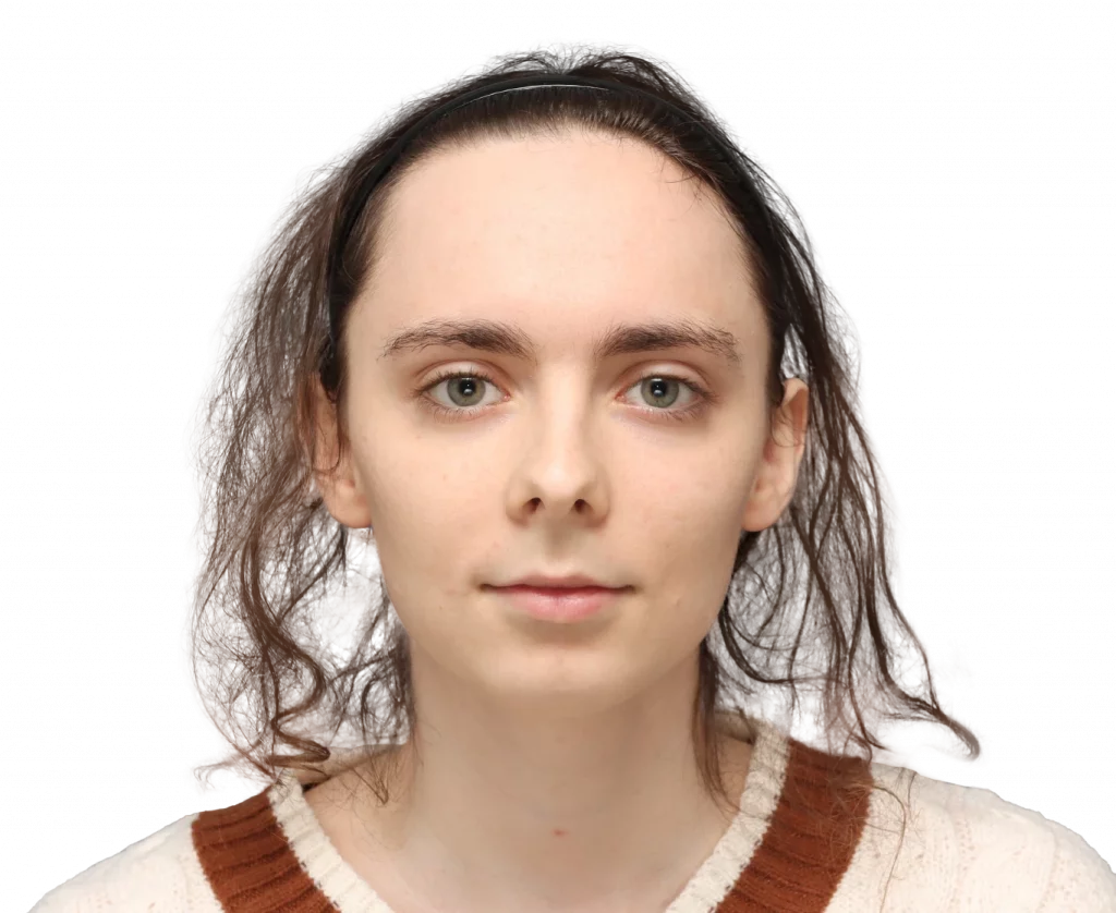 Frontal profile photo of Alex M before surgery.