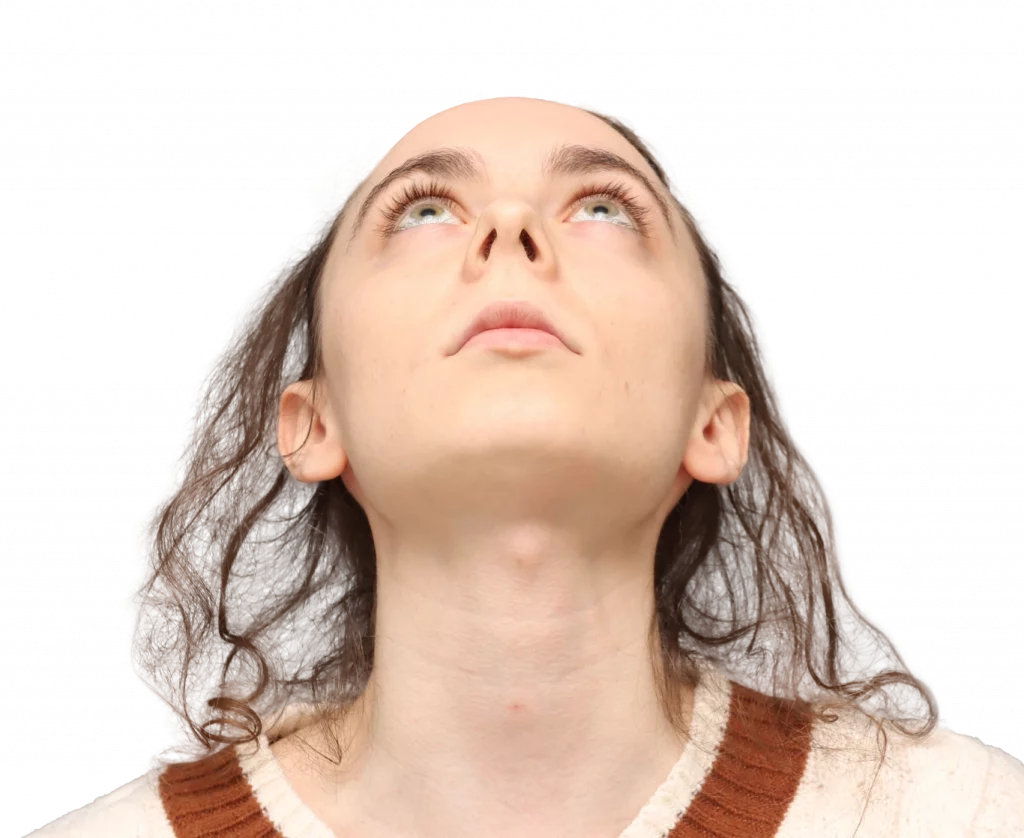 Frontal up profile photo of Alex M before surgery.