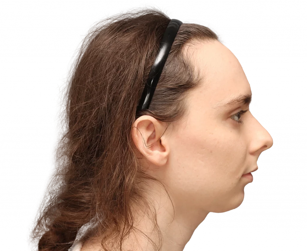 Side right profile photo of Alex M before surgery.