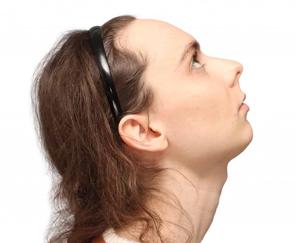 Side right up profile photo of Alex M before surgery.