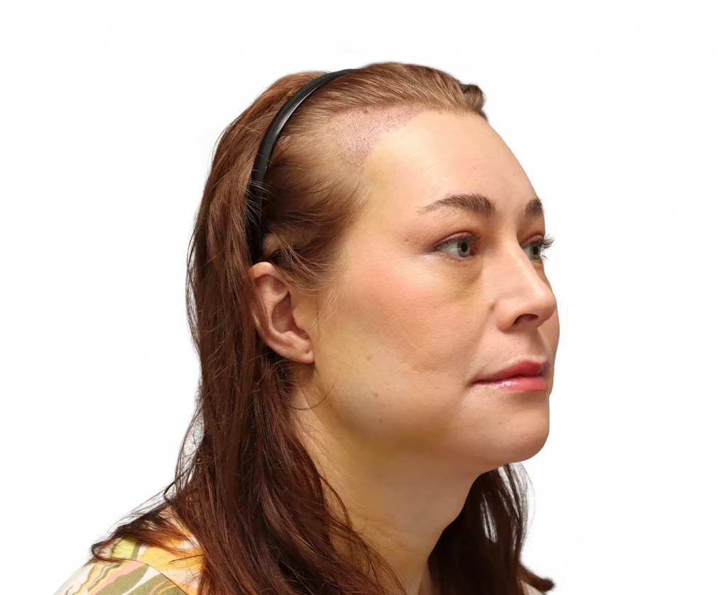 Angled right profile photo of Juuli after surgery.