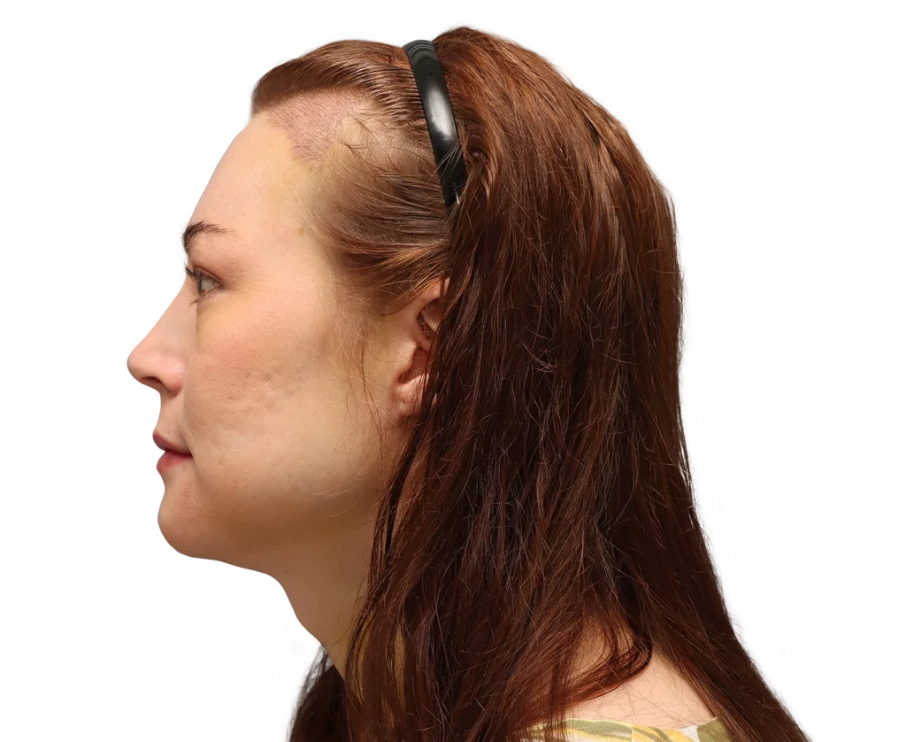 Side left profile photo of Juuli after surgery.