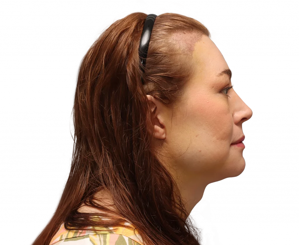 Side right profile photo of Juuli after surgery.