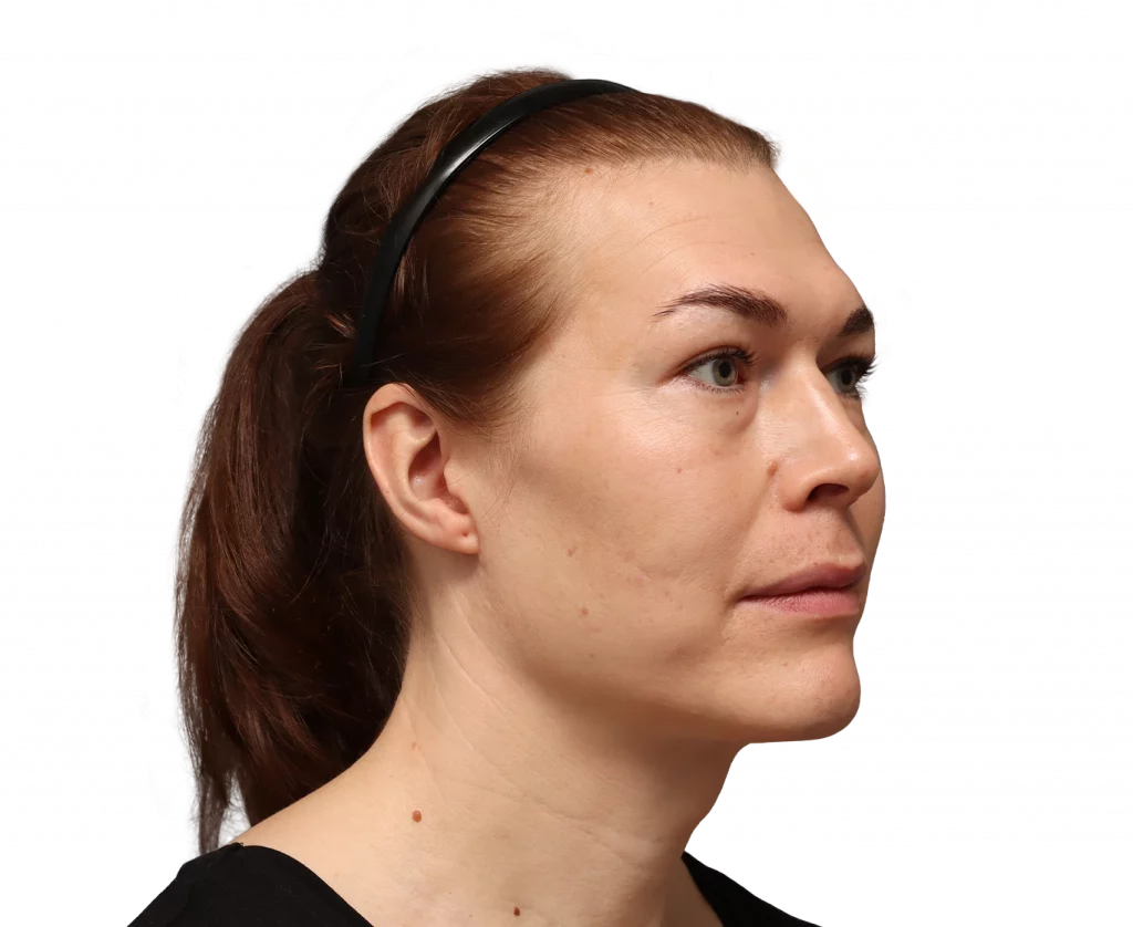 Angled right profile photo of Juuli before surgery.