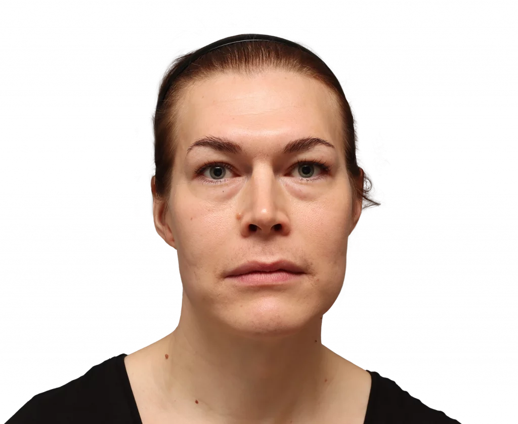 Front profile photo of Juuli before surgery.