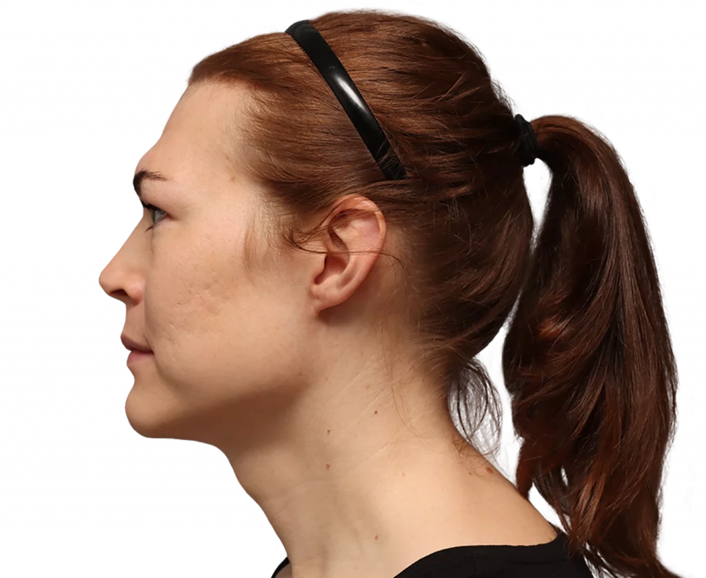 Side left profile photo of Juuli before surgery.