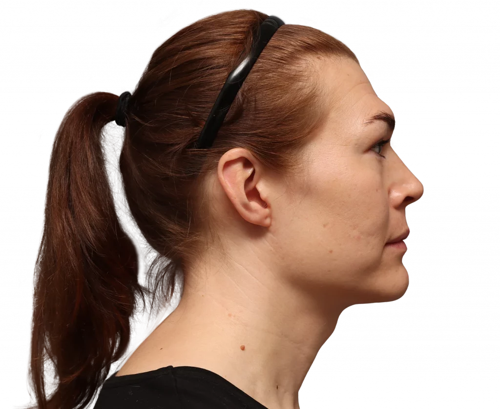 Side right profile photo of Juuli before surgery.