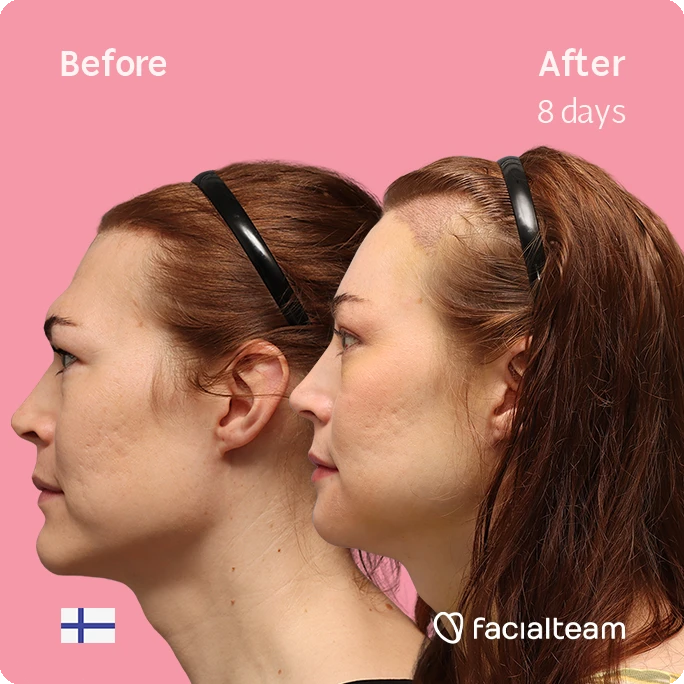Side left square image of FFS patient Juuli showing the results before-after with Facialteam consisting of Forehead with SHT, chin, jaw feminization surgery and HIFU as complementary procedure.