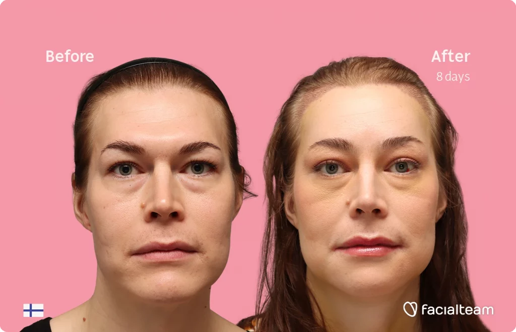 Frontal image of FFS patient Juuli showing the results before-after with Facialteam consisting of Forehead with SHT, chin, jaw feminization surgery and HIFU as complementary procedure.