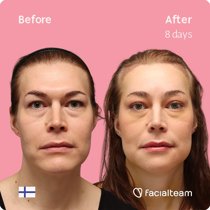 Frontal square image of FFS patient Juuli showing the results before-after with Facialteam consisting of Forehead with SHT, chin, jaw feminization surgery and HIFU as complementary procedure.