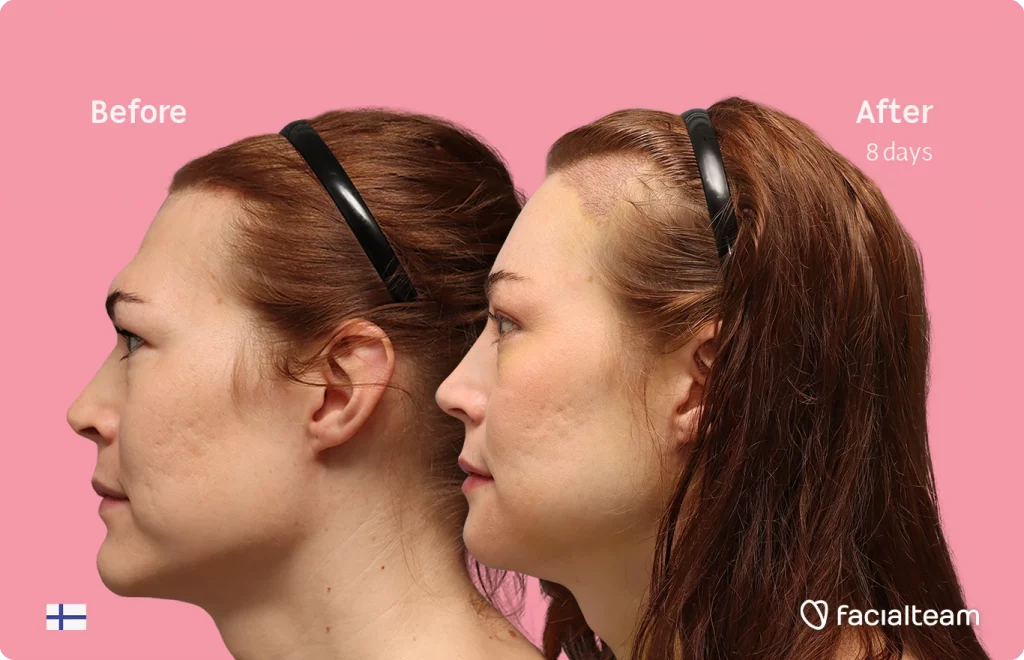 Side left image of FFS patient Juuli showing the results before-after with Facialteam consisting of Forehead with SHT, chin, jaw feminization surgery and HIFU as complementary procedure.