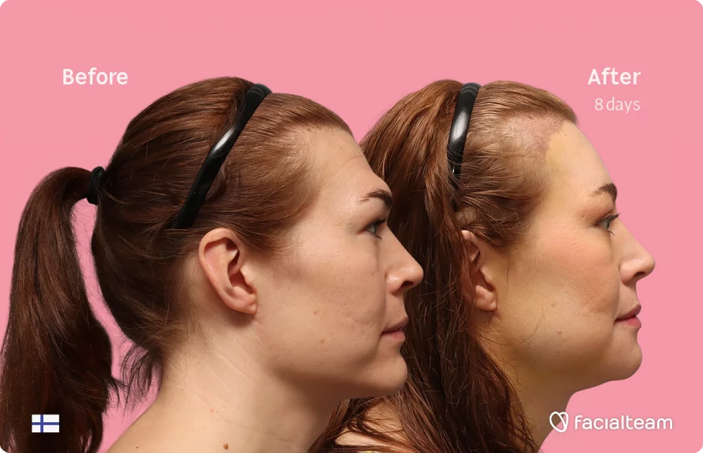 Side right image of FFS patient Juuli showing the results before-after with Facialteam consisting of Forehead with SHT, chin, jaw feminization surgery and HIFU as complementary procedure.