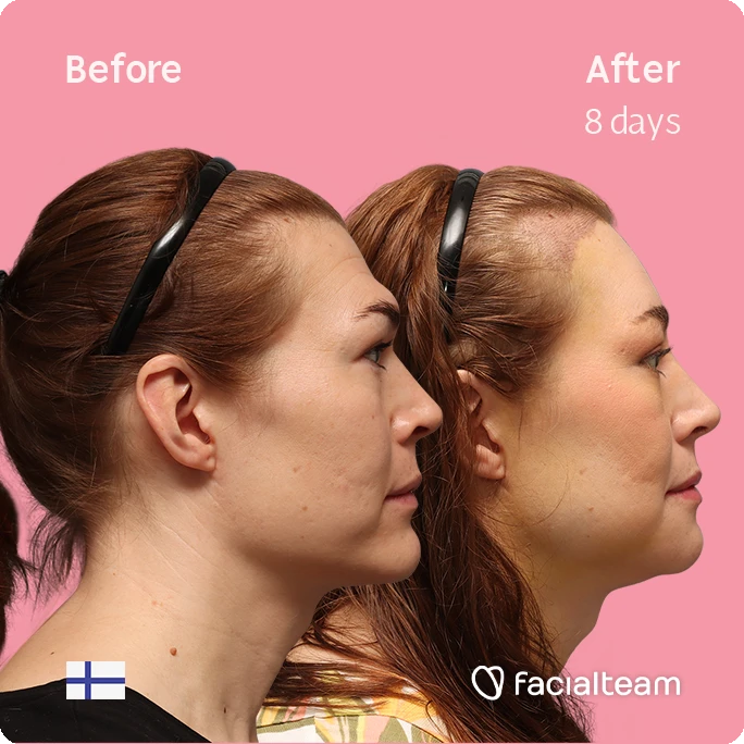 Side right square image of FFS patient Juuli showing the results before-after with Facialteam consisting of Forehead with SHT, chin, jaw feminization surgery and HIFU as complementary procedure.