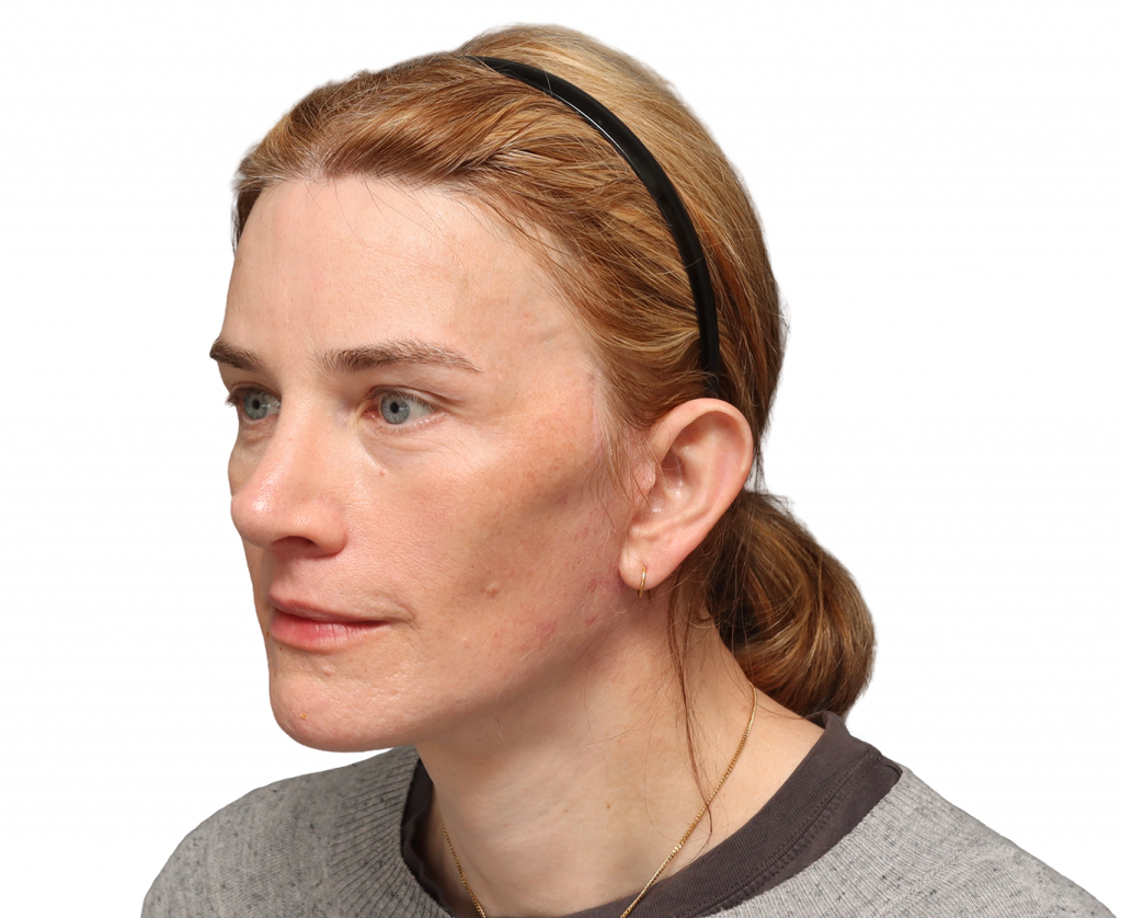 Angled left profile photo of Nina S after surgery.