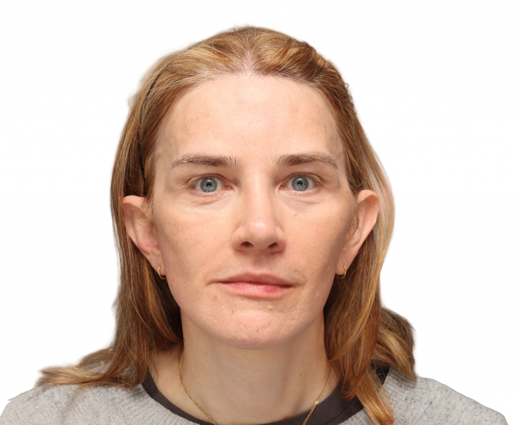 Frontal profile photo of Nina S after surgery.