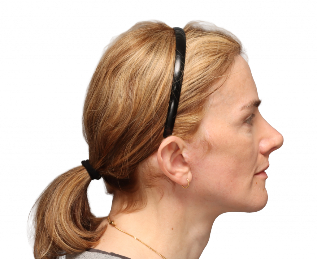 Side right profile photo of Nina S after surgery.