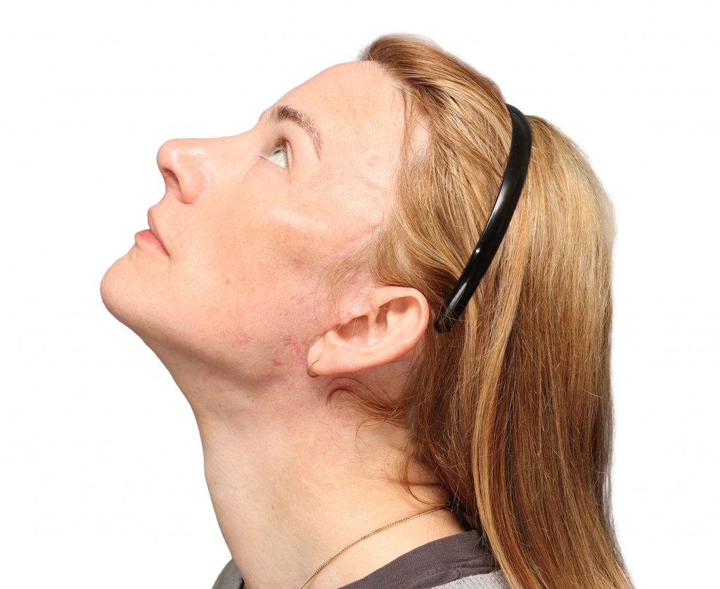 Side left up profile photo of Nina S after surgery.