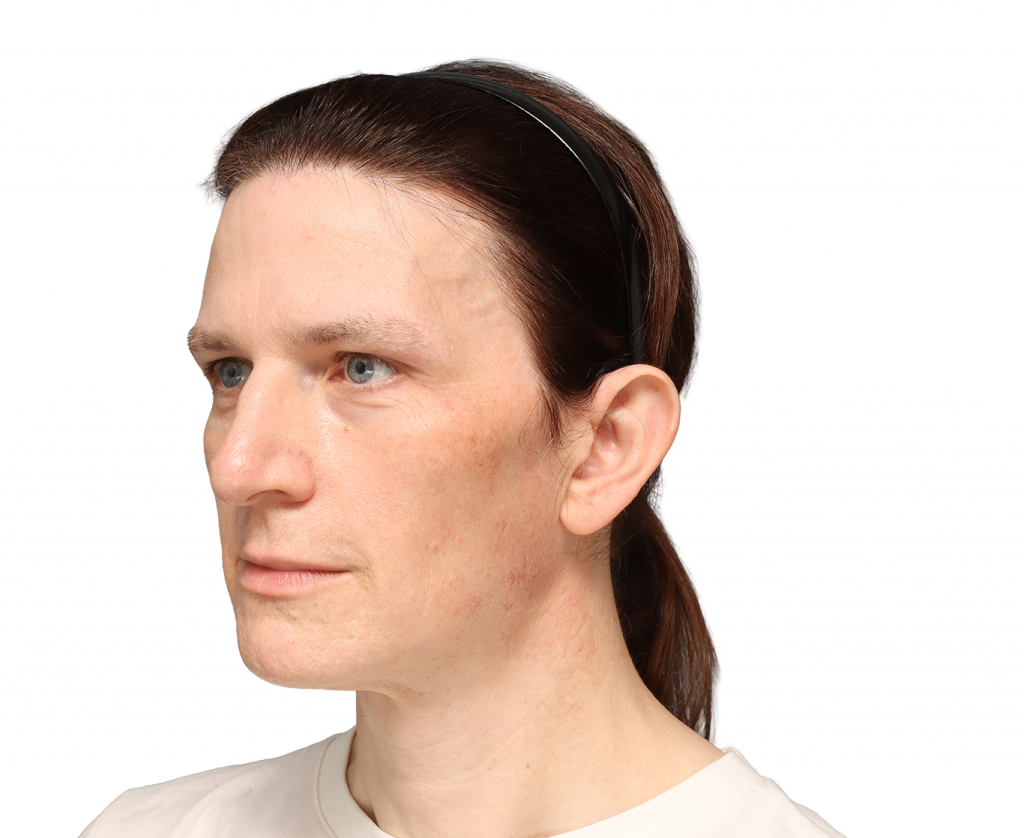 Angled left profile photo of Nina S before surgery.