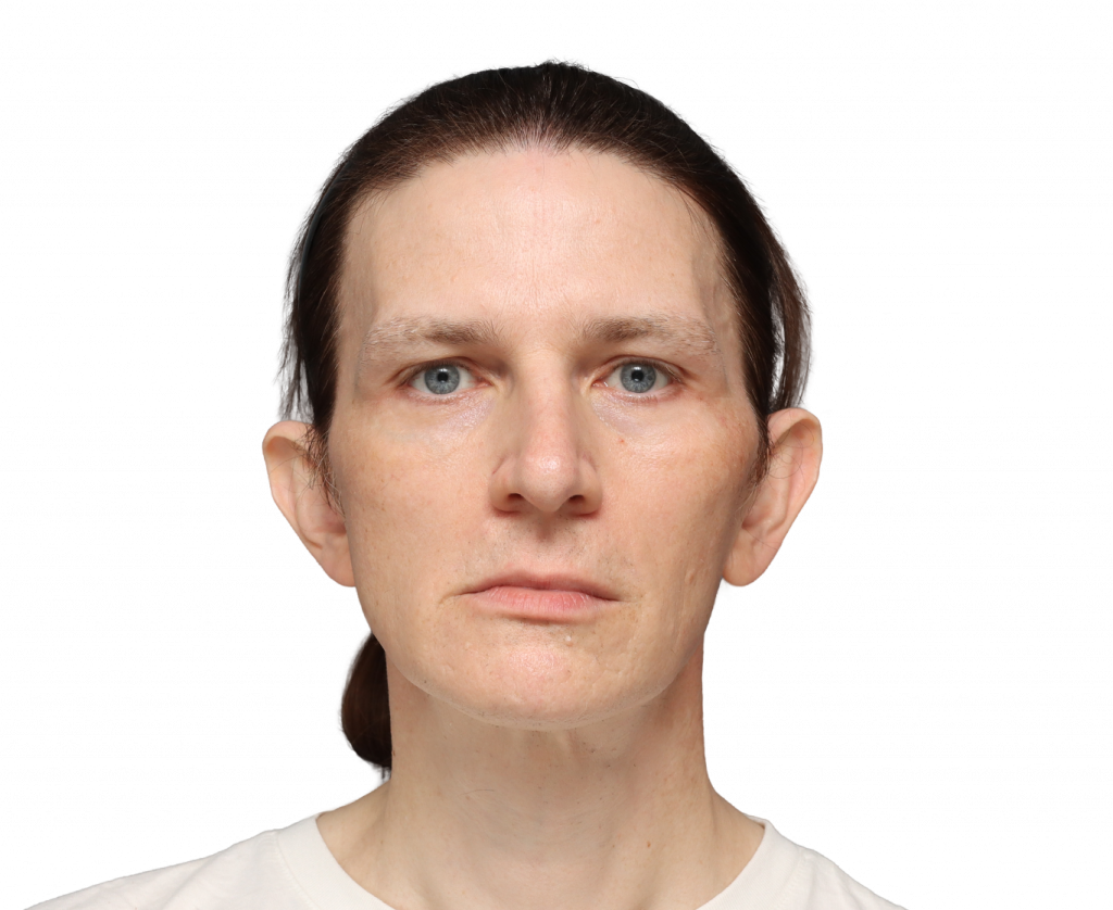 Frontal profile photo of Nina S before surgery.