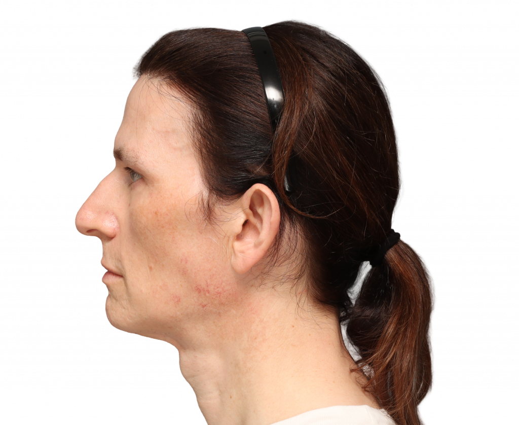 Side left profile photo of Nina S before surgery.