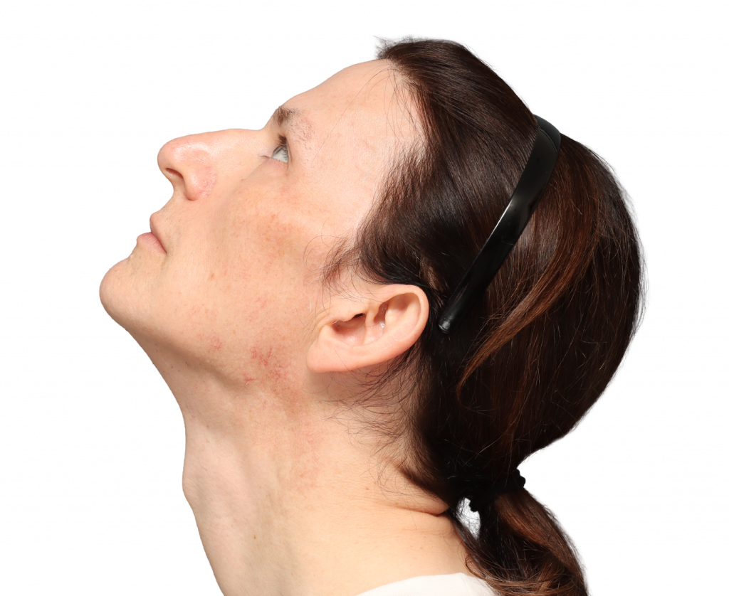 Side left up profile photo of Nina S before surgery.