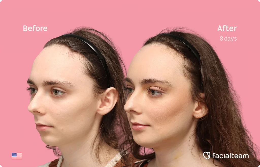 Angled left image of FFS patient Alex M showing the results before-after with Facialteam consisting of Forehead, chin Feminization and tracheal shave.