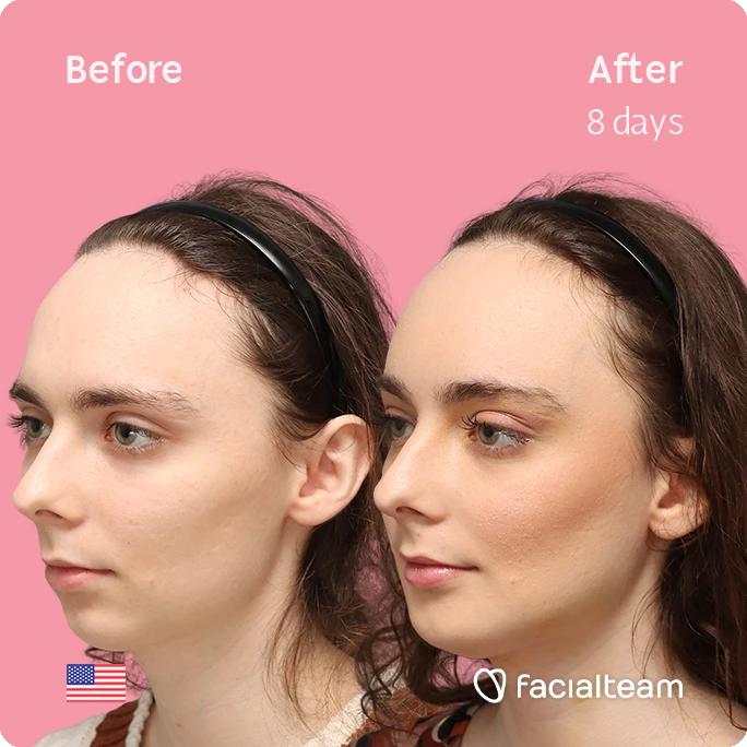 Angled left square image of FFS patient Alex M showing the results before-after with Facialteam consisting of Forehead, chin Feminization and tracheal shave.