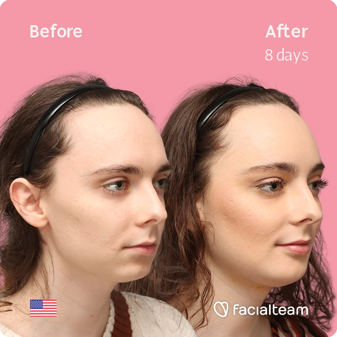 Angled right square image of FFS patient Alex M showing the results before-after with Facialteam consisting of Forehead, chin Feminization and tracheal shave.